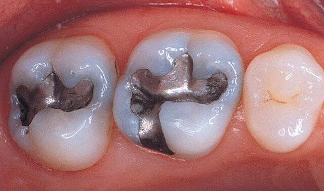 Quando a Restauração Envelhece: o Que a Sua Obturação Está Tentando Avisar