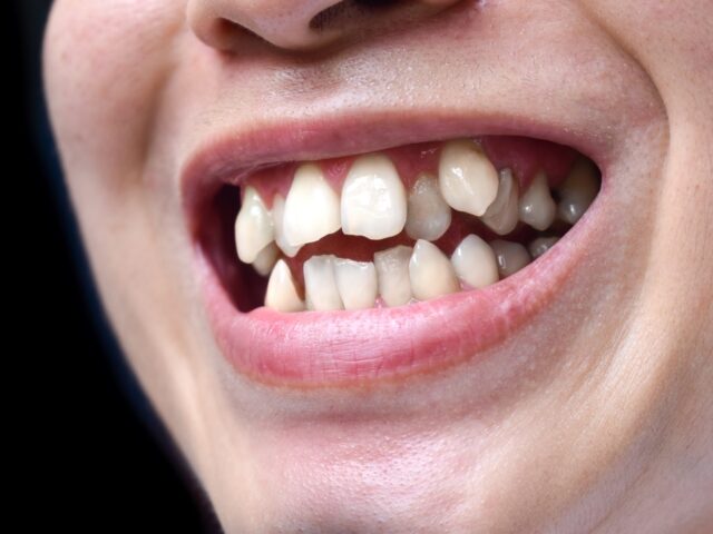 Dente encavalado: causas, tratamentos e quando procurar um dentista