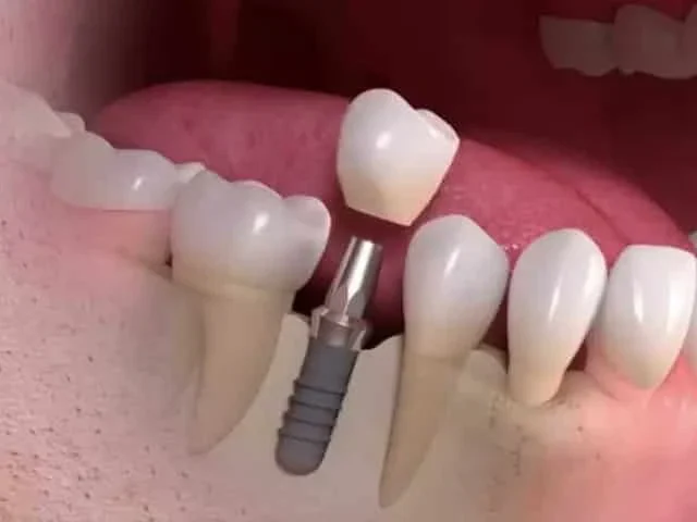 Implantes Dentários e a Saúde Sistêmica: Por que a Reposição Imediata é Vital?