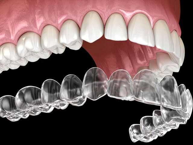 Ortodontia Invisível: A Ciência por Trás da Previsibilidade do Invisalign