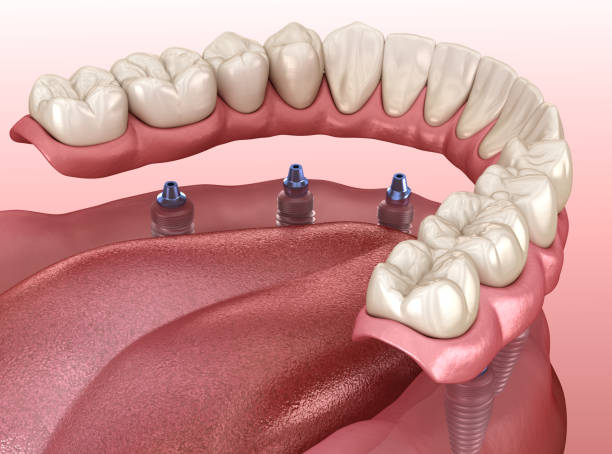 A Revolução da Carga Imediata: Como a BeSmile Interlagos Transforma Sorrisos em um Único Dia